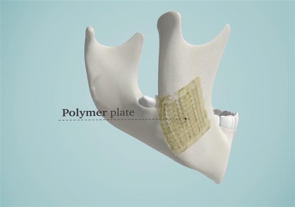 解決醫生煩惱 3D打印生物陶瓷修復骨骼
生物陶瓷,3D打印生物陶瓷,工業3d打印機,3D打印機價格,3D打印服務,3D打印技術,中國3d打印技術,上海3D打印,北京3D打印