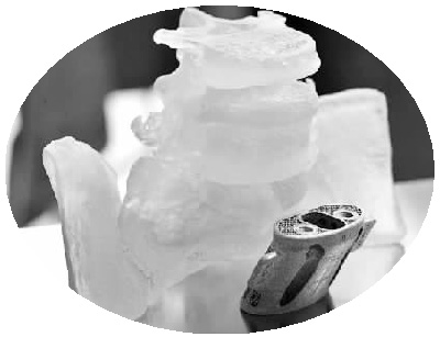 3D打印個(gè)體化適型鈦合金人工骶椎