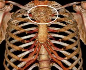 第四軍醫大學精彩分享個性化醫療3D打印的實戰案例與研究成果 第四軍醫大學精彩分享個性化醫療3D打印的實戰案例與研究成果