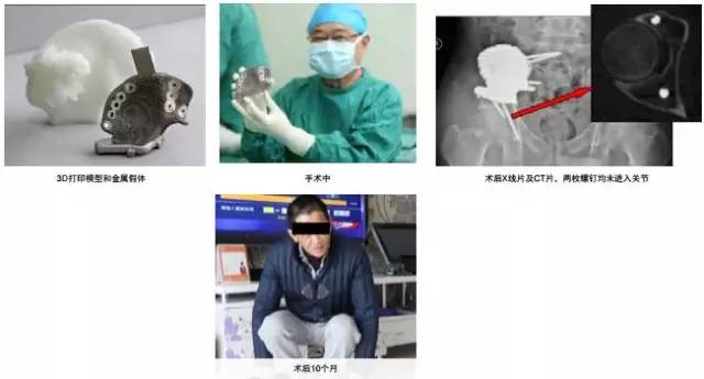 3d打印在醫(yī)療領(lǐng)域的應(yīng)用 3D打印與醫(yī)療行業(yè)白皮書 3d打印在醫(yī)療領(lǐng)域的應(yīng)用 3D打印與醫(yī)療行業(yè)白皮書