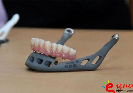 3D打印牙嵌體和牙套哪種更好？3D打印牙齒/隱形牙套/牙冠/模型/成品價格表
