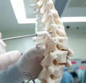 脊椎金屬植入物4